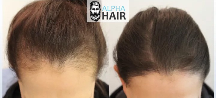השתלת שיער לנשים לפני ואחרי