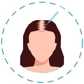 הרדמה מקומית לפני השתלת שיער אצל אשה
