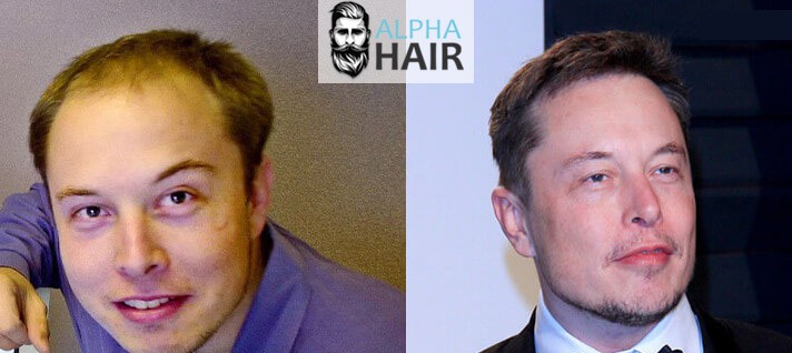 אילון מאסק לפני ואחרי השתלת שיער