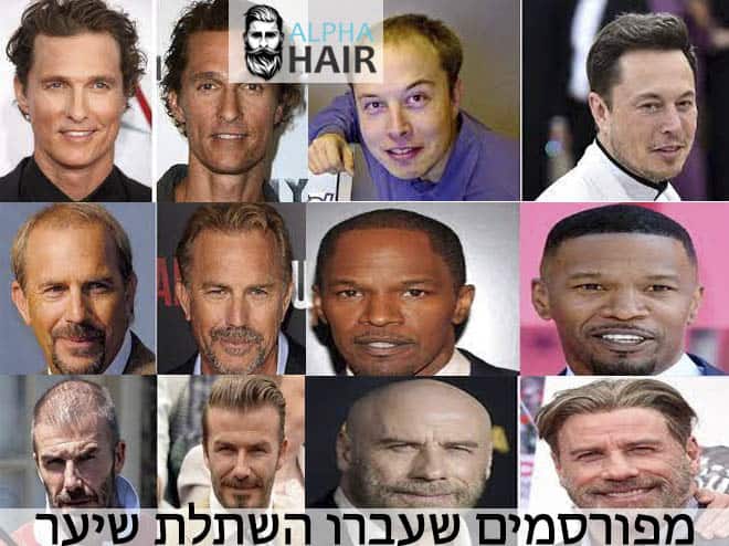 מפורסמים שעשו השתלת שיער