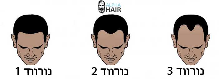 מטופלים מתאימים להשתלת שיער ללא גילוח נורווד 1-3