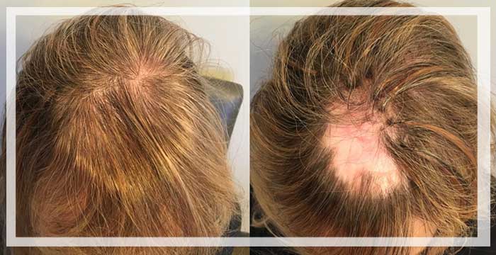 לפני ואחרי השתלת שיער לכיסוי צלקת בקדחת הראש