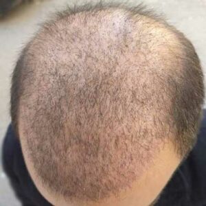ראש מטופל לאחר השתלת שיער - כחודש