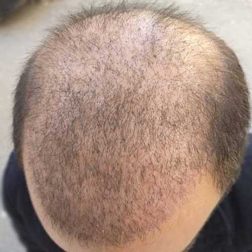 ראש מטופל לאחר השתלת שיער - כחודש